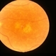 Fundus flavimaculatus Fundus flavimaculatus